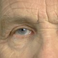 Can I Have Both Eyes Done at the Same Time for Cataract Surgery?
