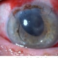 What are the Most Common Postoperative Complications After Cataract Surgery?