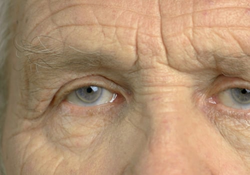 Can I Have Both Eyes Done at the Same Time for Cataract Surgery?