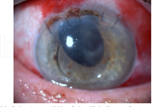 What are the Most Common Postoperative Complications After Cataract Surgery?